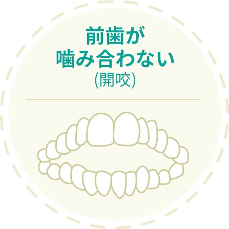 開咬 前歯が噛み合わない