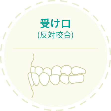 反対咬合 下顎が出ている