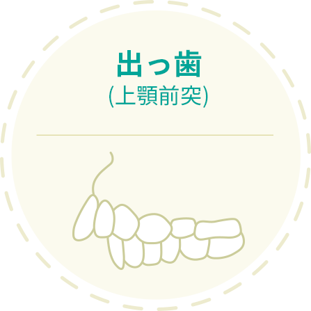 上顎前突 前歯が出ている