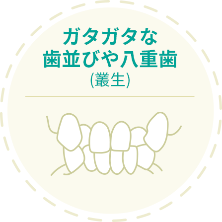 叢生 歯並びがガタガタ