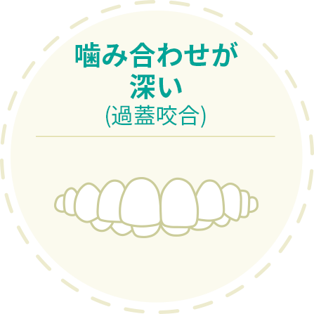 過蓋咬合 噛み合わせが深い